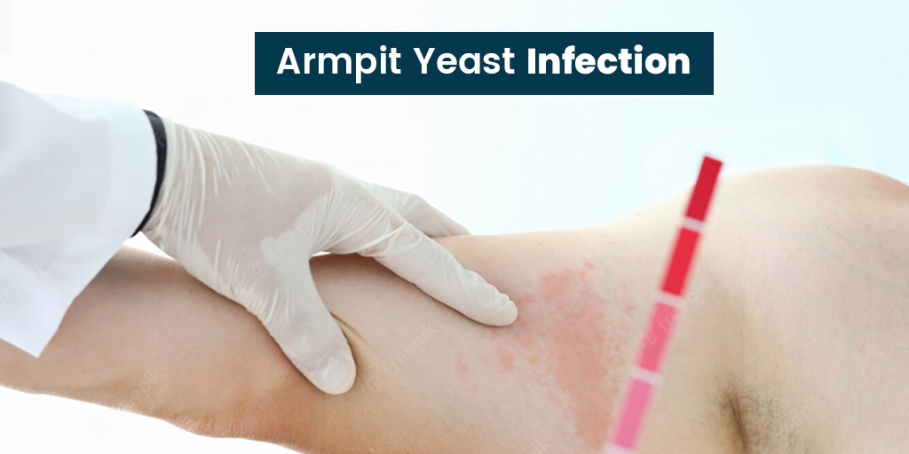 Armpit Yeast Infection Symptoms Causes Prevention Tips Onlymyhealth